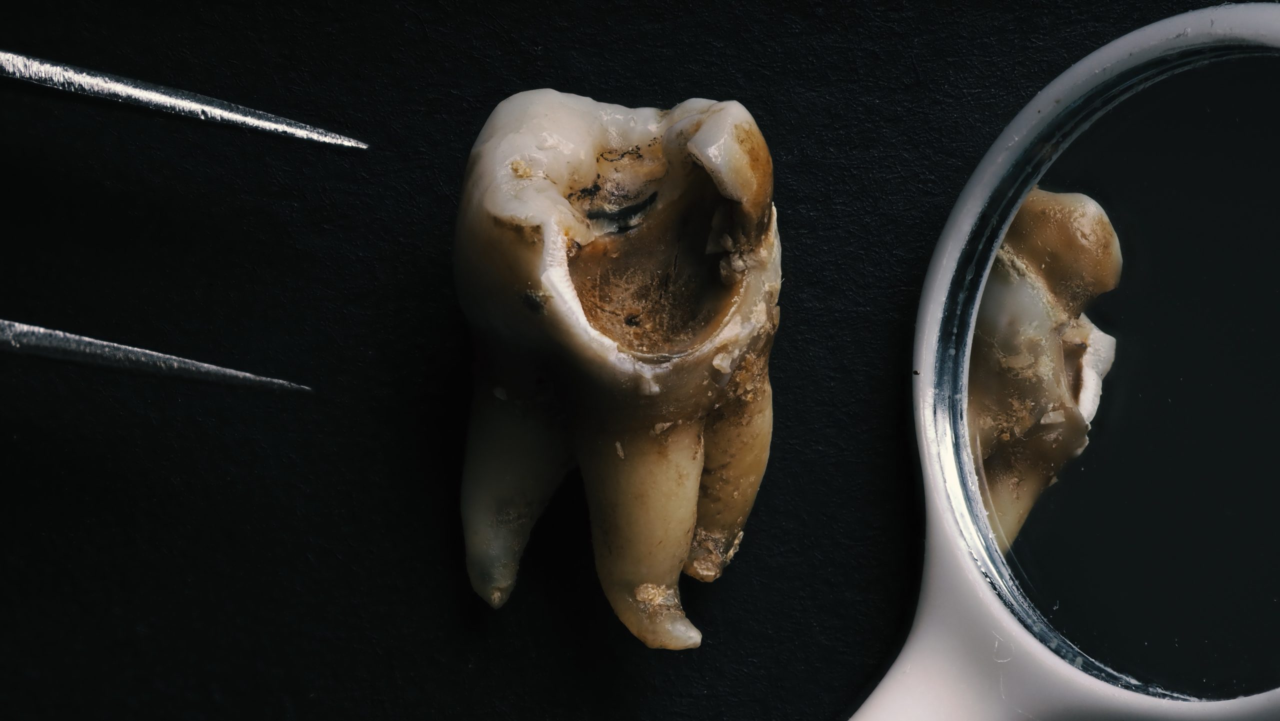 macro shot of a decayed tooth rotting to show that meth ruins teeth